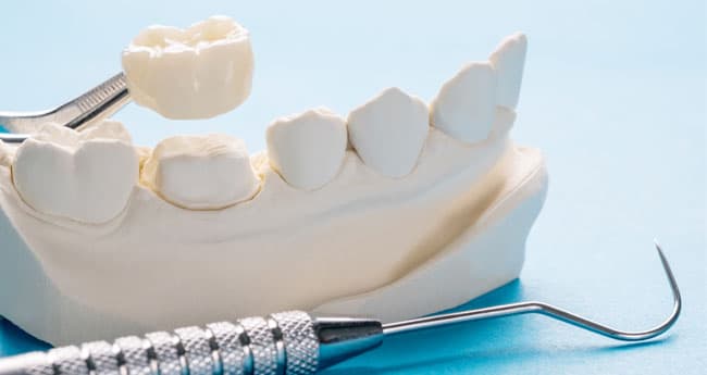 Implantes dentales