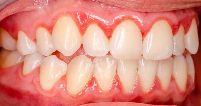 Periodoncia