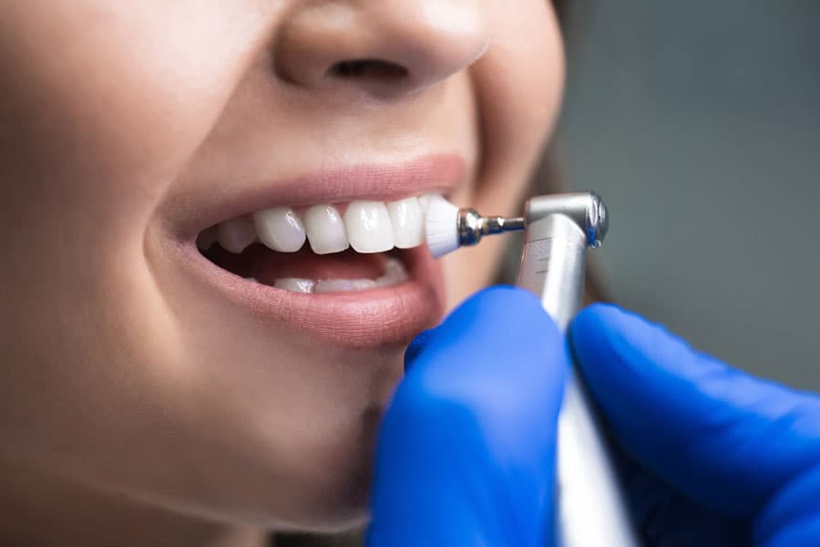 Cuestiones de interés sobre las carillas dentales