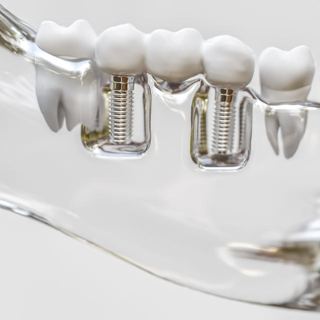 Implantes dentales en Ourense