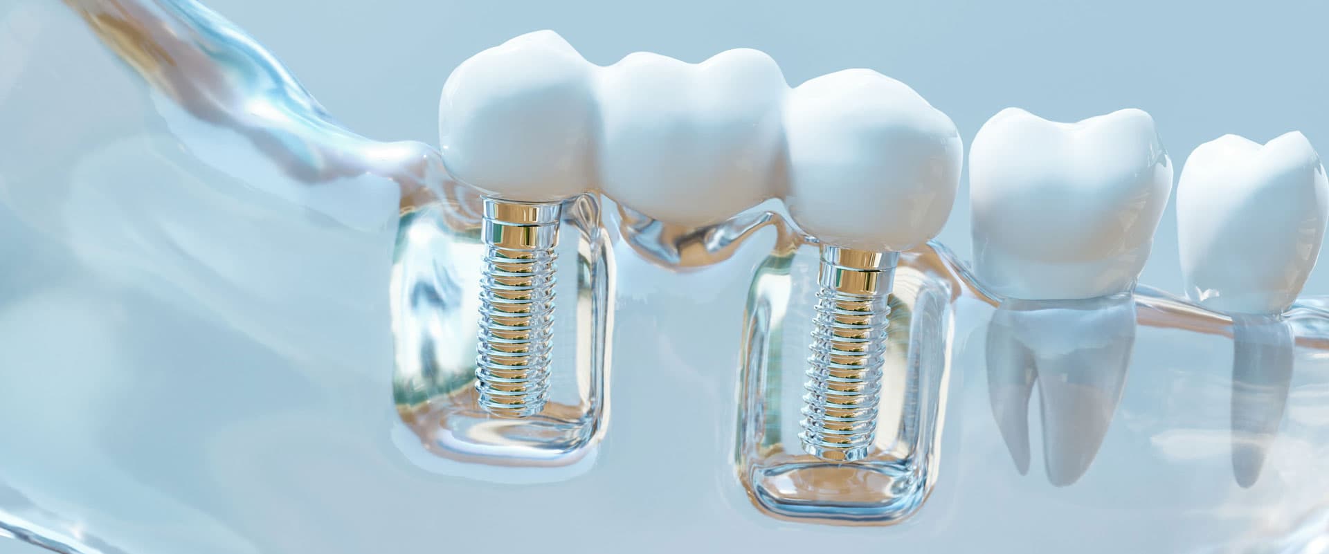 ¿Necesitas implantes dentales?