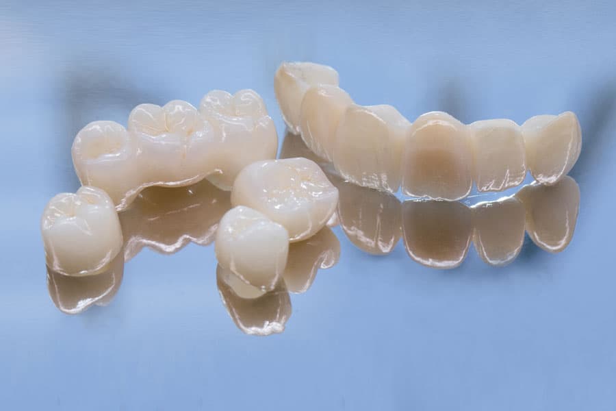 ¿Qué son las carillas dentales?